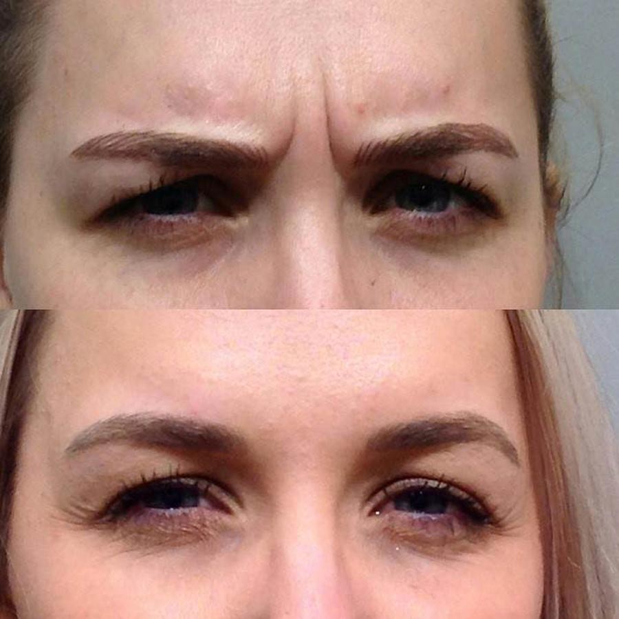 جایگزین بوتاکس برای خط اخم