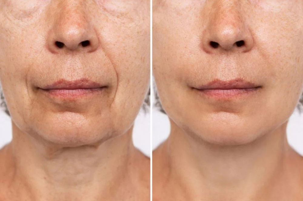 اگزوزوم صورت جدیدترین روش جوانسازی