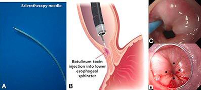 تزریق بوتاکس معده برای لاغری