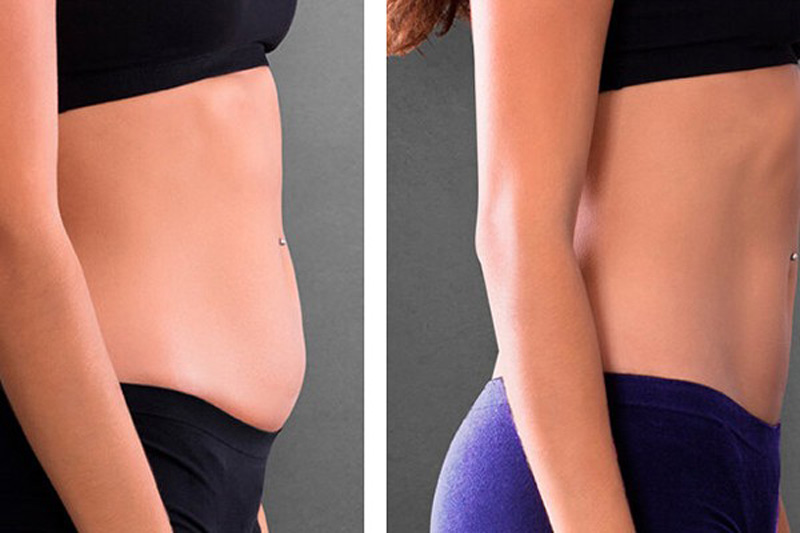 بوتاکس لاغری یا ای ام اسلیم EMSlim