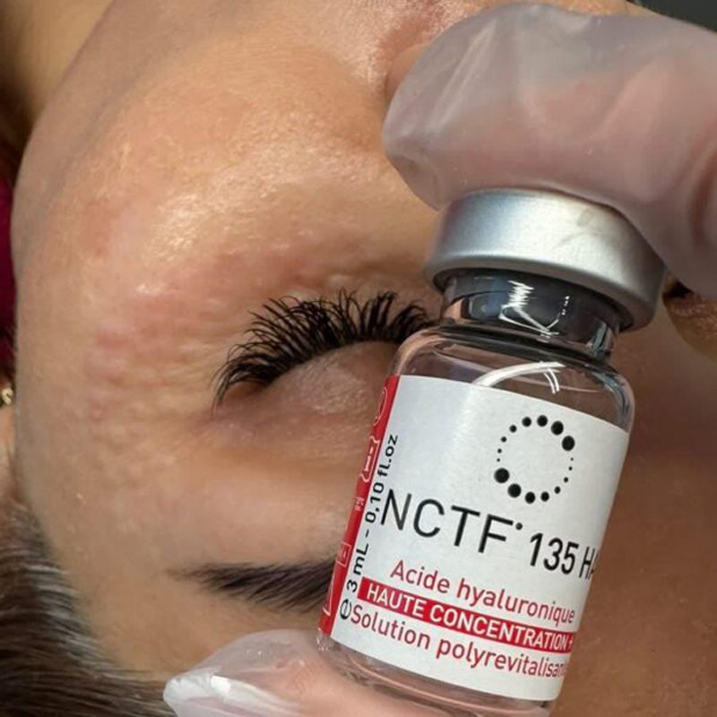 روش جوانسازی صورت ان سی تی اف