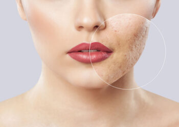 فیلر بایو استیمولاتور تحریک کلاژن سازی صورت