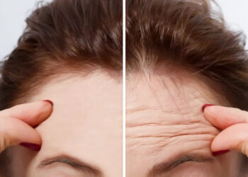 بوتاكس پيشاني