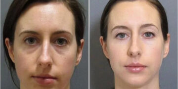 نانوفت برای جوانسازی زیر چشم