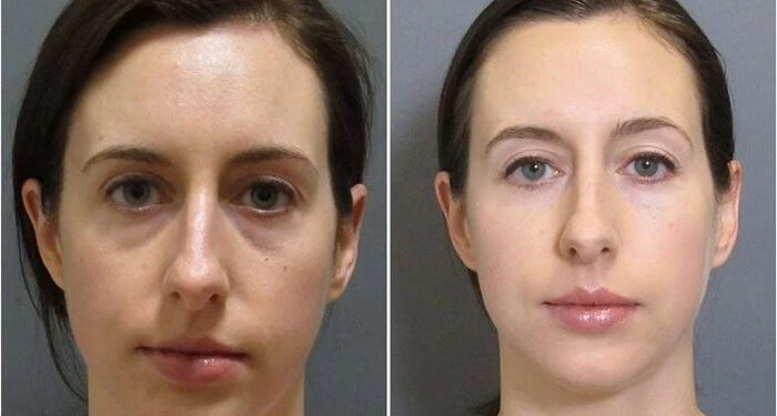 نانوفت برای جوانسازی زیر چشم