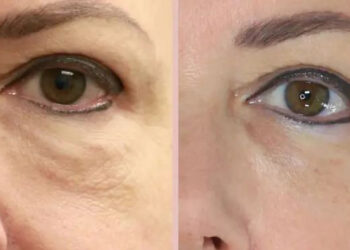 سل تراپی برای جوانسازی صورت