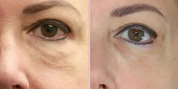 سل تراپی برای جوانسازی صورت