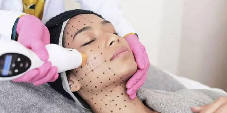 جوانسازی پوست با روش ترماژ