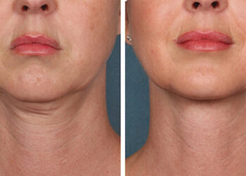 درمان خانگی لاغری صورت