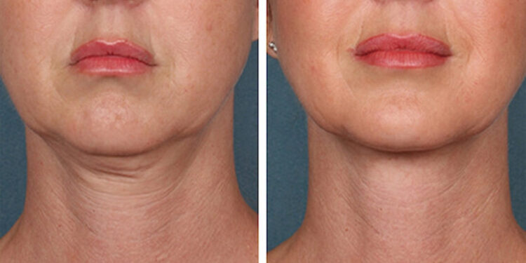 درمان خانگی لاغری صورت