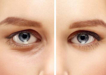 قاصدک برای جوانسازی زیر چشم