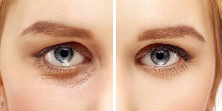 قاصدک برای جوانسازی زیر چشم