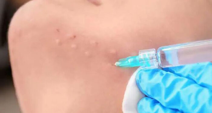 مزوتراپی برای لاغری صورت