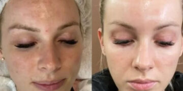 معجزه مزونیدلینگ