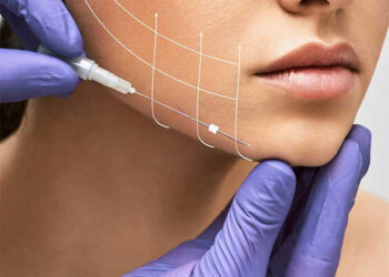 نخ کلاژن صورت pdo چیست