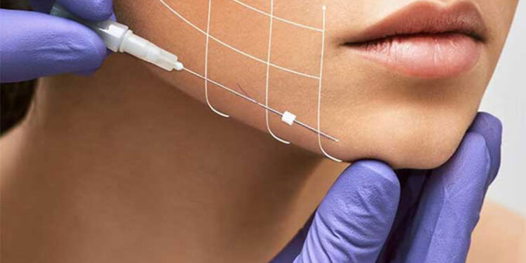 نخ کلاژن صورت pdo چیست