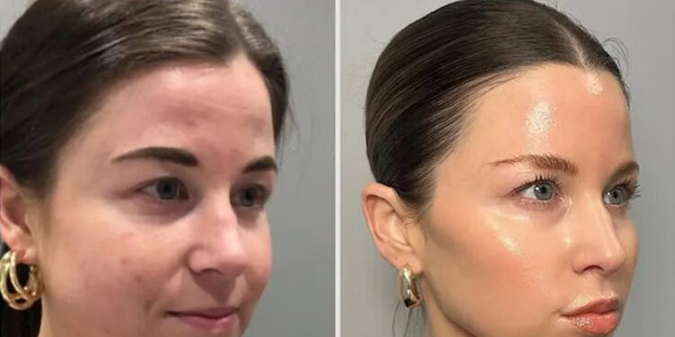 معجزه مزونیدلینگ بر جوانسازی صورت