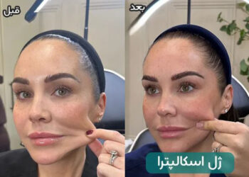 فیلر کلاژن ساز اسکالپترا Sculptra