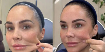 فیلر کلاژن ساز اسکالپترا Sculptra