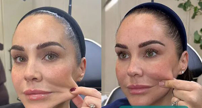 فیلر کلاژن ساز اسکالپترا Sculptra