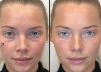 پر شدن گودی زیر چشم