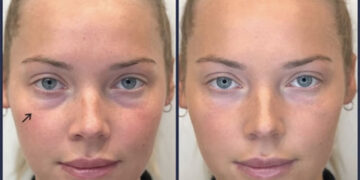 پر شدن گودی زیر چشم