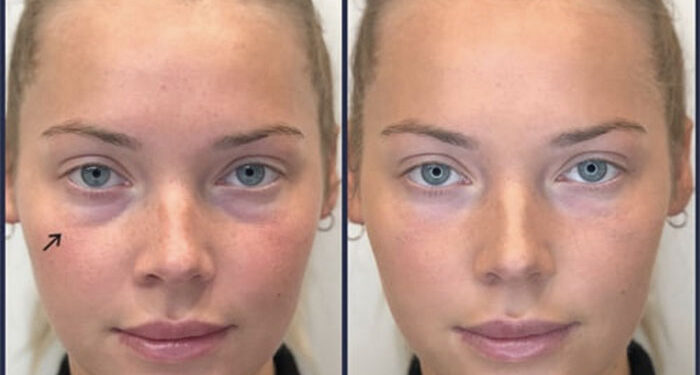 پر شدن گودی زیر چشم