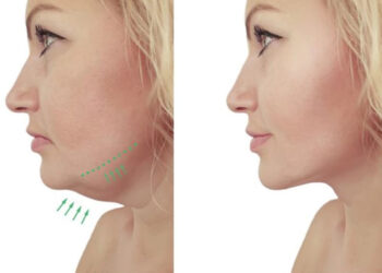 سریع ترین روش رفع غبغب صورت