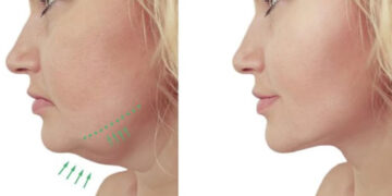 سریع ترین روش رفع غبغب صورت