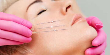 نخ کلاژن جذبی جوانسازی صورت