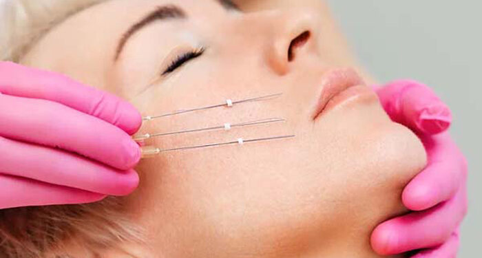 نخ کلاژن جذبی جوانسازی صورت