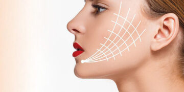 نخ امبدینگ برای لاغری صورت