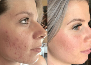 مزونیدلینگ صورت برای جای جوش