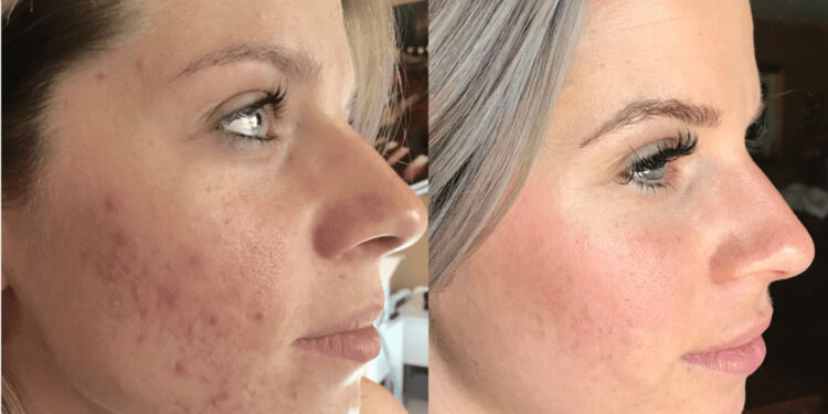 مزونیدلینگ صورت برای جای جوش