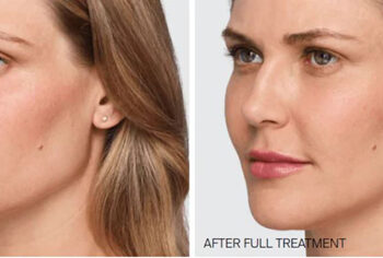 نخ مایع یا PLLA جوانسازی صورت