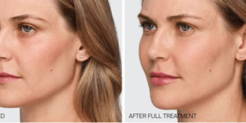 نخ مایع یا PLLA جوانسازی صورت