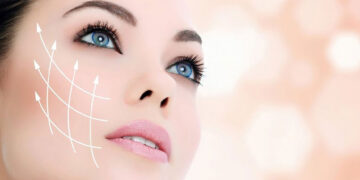 لیفت صورت در لایه SMAS با اندولیفت