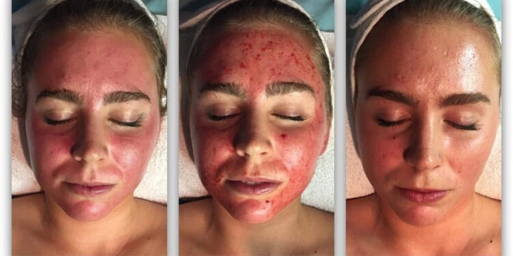 ميكرونيدلينگ صورت