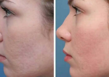 اربیوم صورت