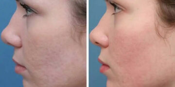 اربیوم صورت