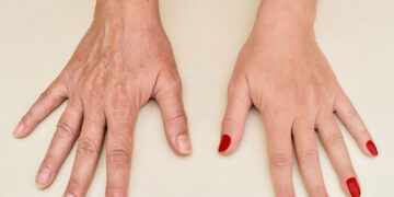 جوانسازی پوست دست