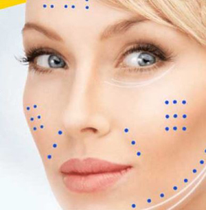 نقاط تزریق مزوتراپی صورت