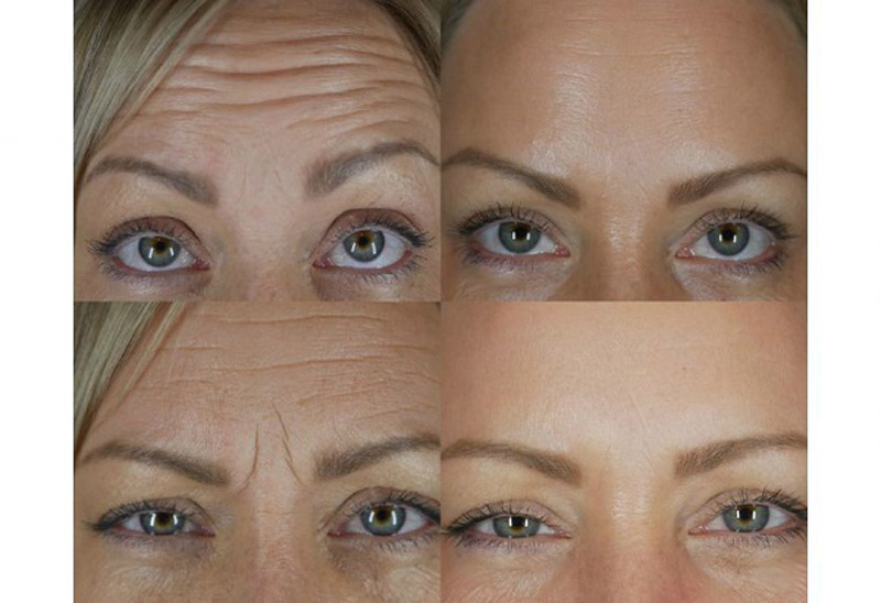 بوتاکس پیشانی