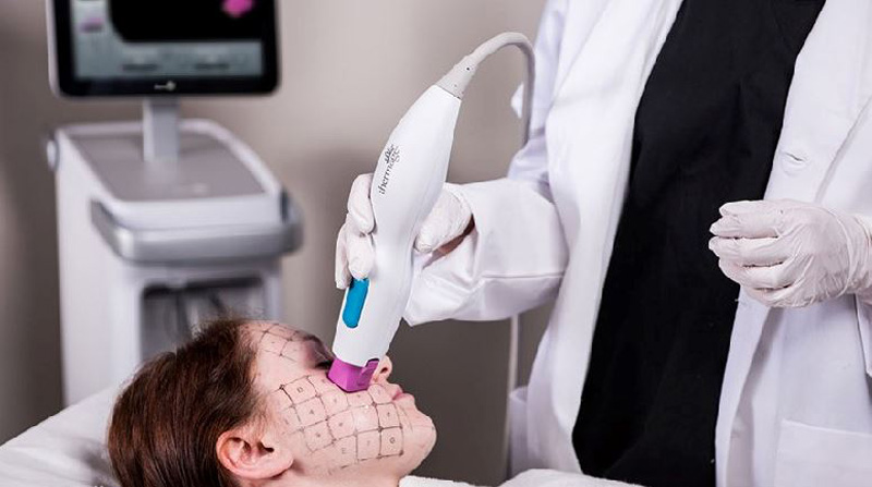 جوانسازی پوست با روش ترماژ