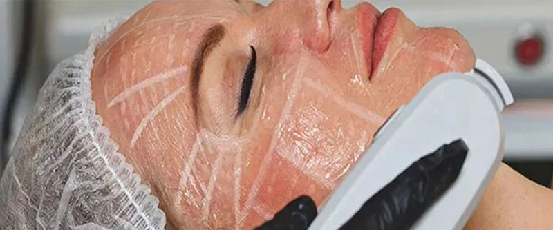 اولتراپی برای سفت کردن پوست صورت