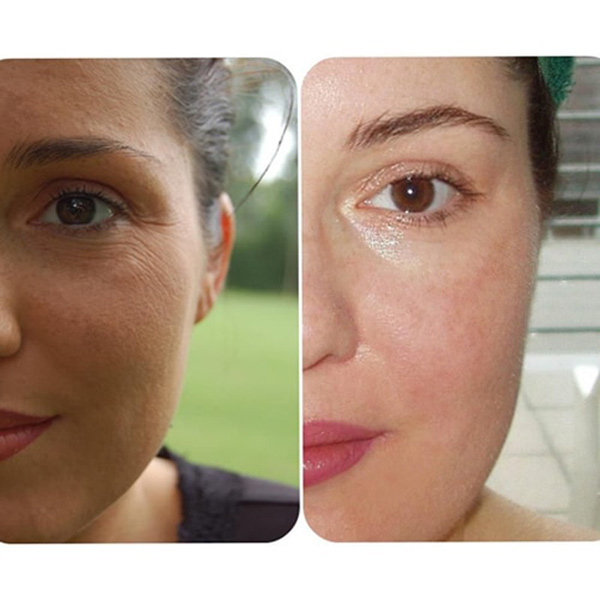 معجزه مزونیدلینگ بر جوانسازی صورت