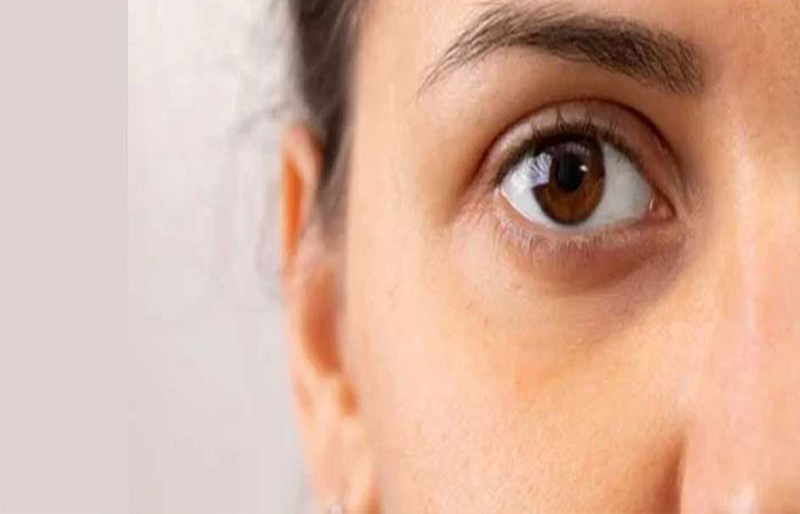 پر شدن گودی زیر چشم