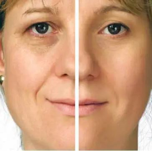 نخ امبدینگ برای لاغری صورت