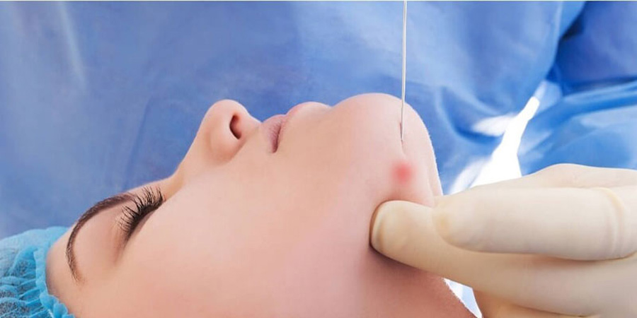 لیفت صورت در لایه SMAS با اندولیفت