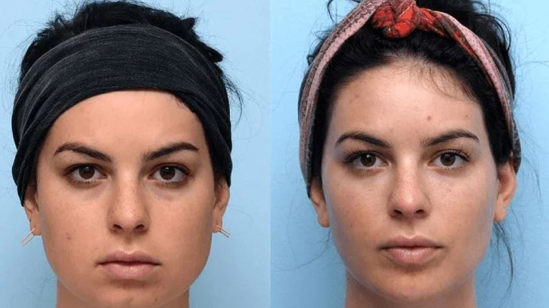 لاغری صورت در یک هفته